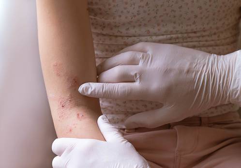SB Online | Neki simptomi koronavirusa mogu se pojaviti na koži: Ovo je pet vrsta osipa nakon zaraze covidom