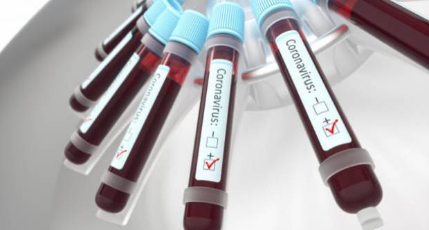SB Online | 52 nova slučaja koronavirusa u posljednja 24 sata, u bolnicama ukupno 75 osoba